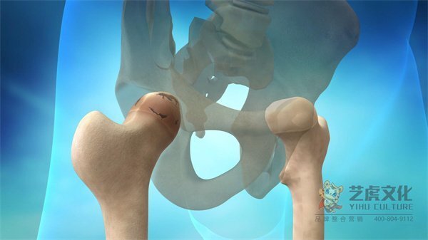 醫學3d動畫演示坐骨神經痛