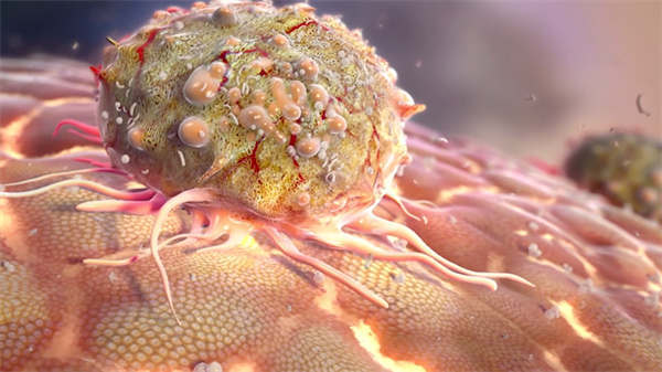 醫(yī)學(xué)3d動畫風(fēng)濕性關(guān)節(jié)炎