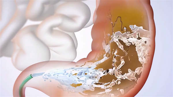 醫學直腸癌切除術3d動畫演示