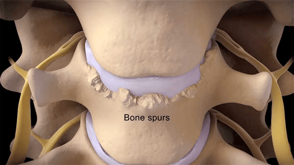3D醫學動畫 二尖瓣成形術