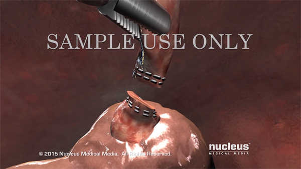 艾滋病醫學動畫中文字幕