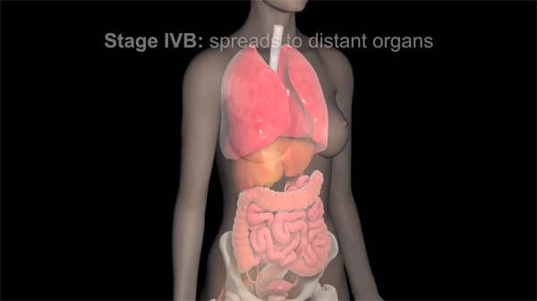 3d醫(yī)學(xué)動畫解釋子宮內(nèi)膜異位癥