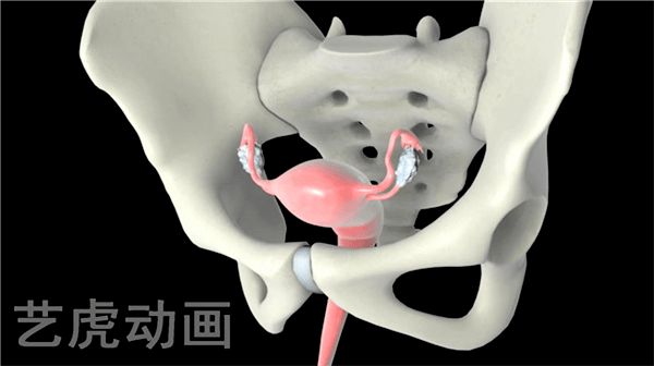 醫(yī)學(xué)3d動(dòng)畫演示多囊卵巢綜合征