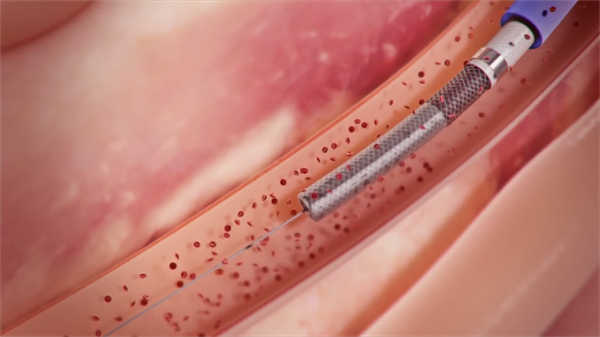 醫(yī)學(xué)3d動(dòng)畫演示男性前列腺炎