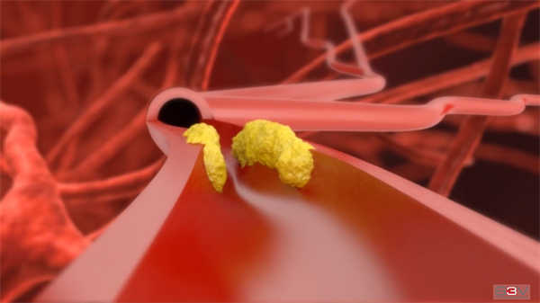 醫(yī)學(xué)3d動(dòng)畫子宮內(nèi)膜異位癥