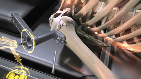 股骨頭壞死的成因3d醫學動畫