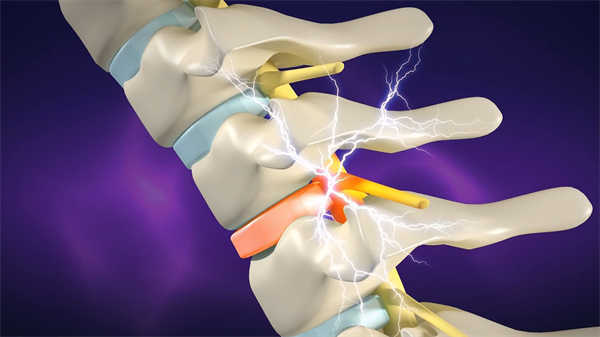 醫(yī)學(xué)科普三維動畫脊柱側(cè)彎