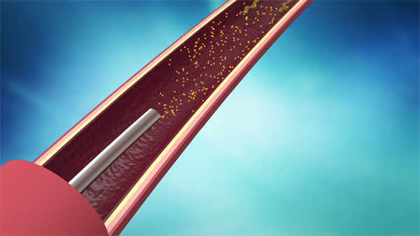 醫(yī)學(xué)3d動畫膽總管微創(chuàng)取石