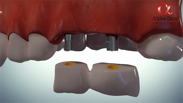 醫(yī)學(xué)換牙動(dòng)畫