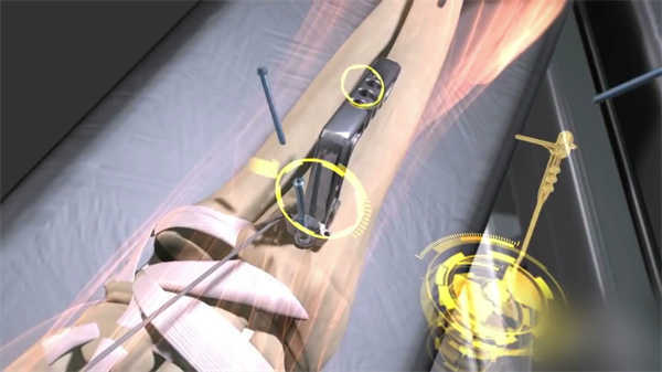 3d立體動畫醫學