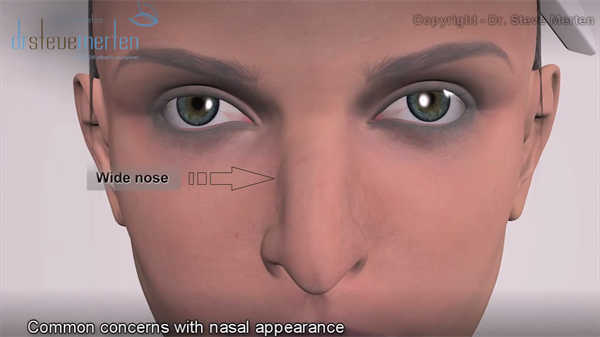 醫學動畫3d鼻子
