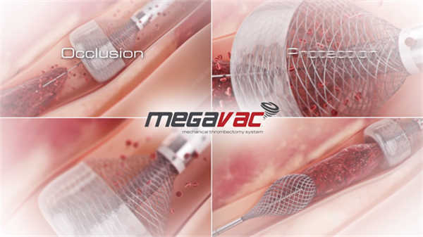 醫(yī)學(xué)男性假體手術(shù)動(dòng)畫